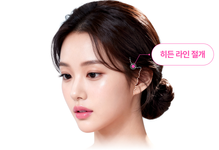 히든 라인 절개