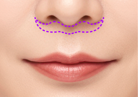 립스마일 리프팅 1단계