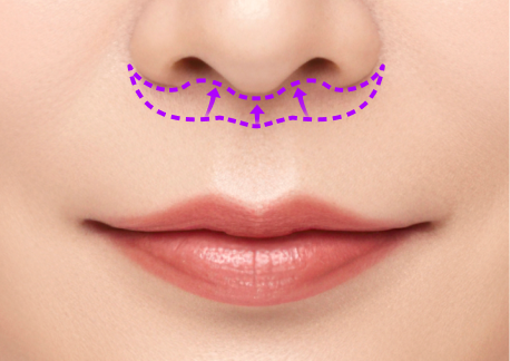 립스마일 리프팅 1단계