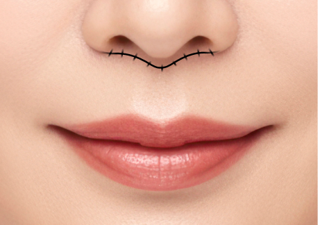 립스마일 리프팅 1단계