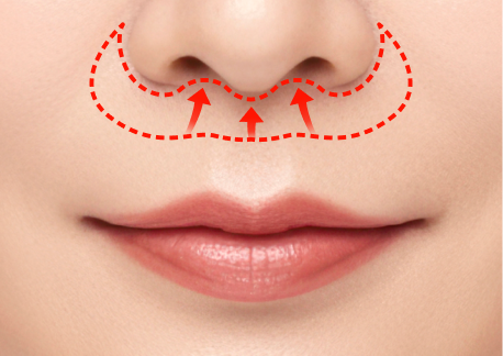립스마일 리프팅 2단계 