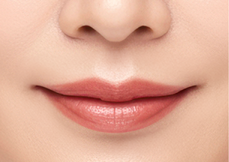 립스마일 리프팅 2단계 