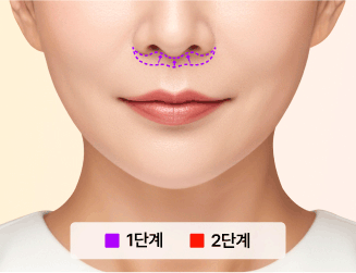 립스마일 리프팅이란?