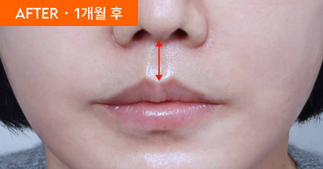 AFTER &middot; 1개월 후