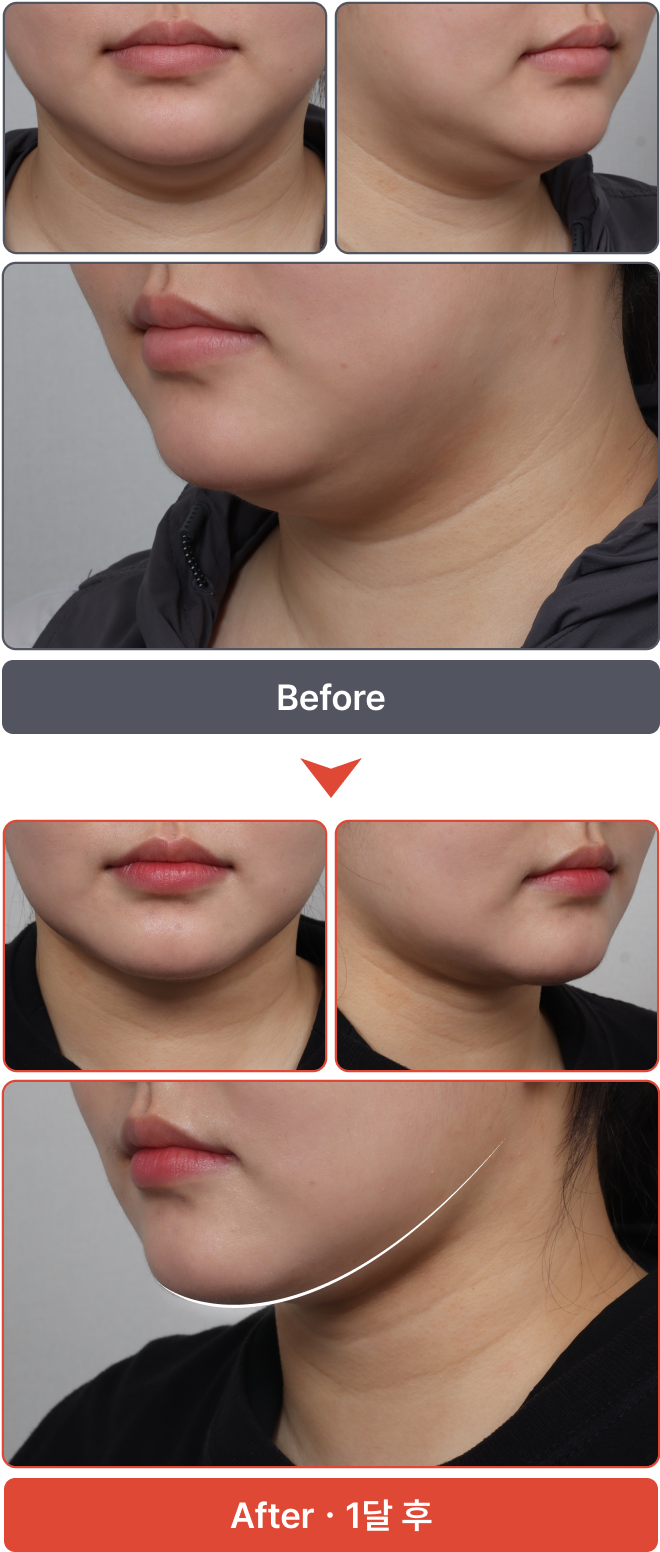 수술 전 이미지