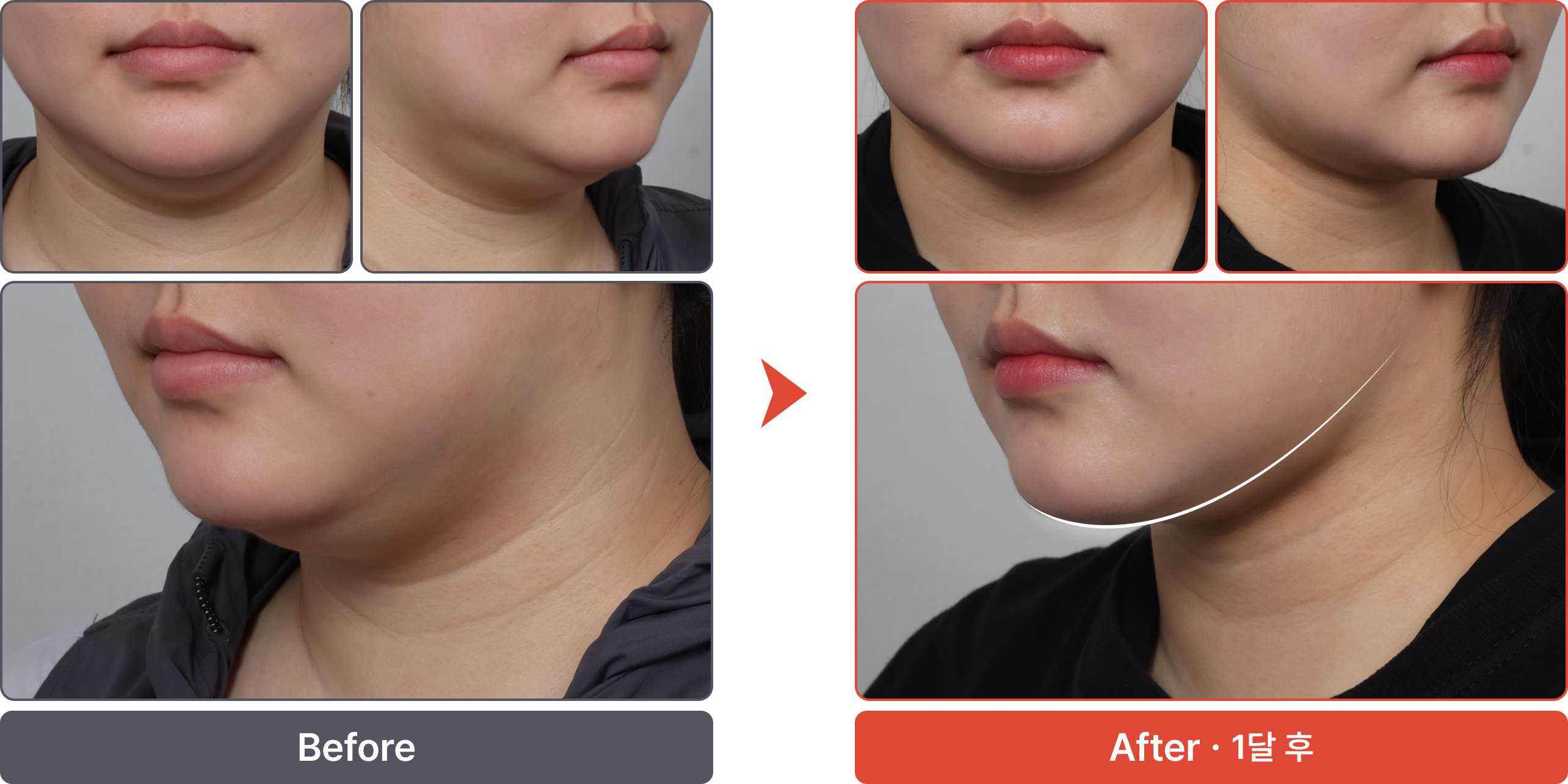 수술 전 이미지