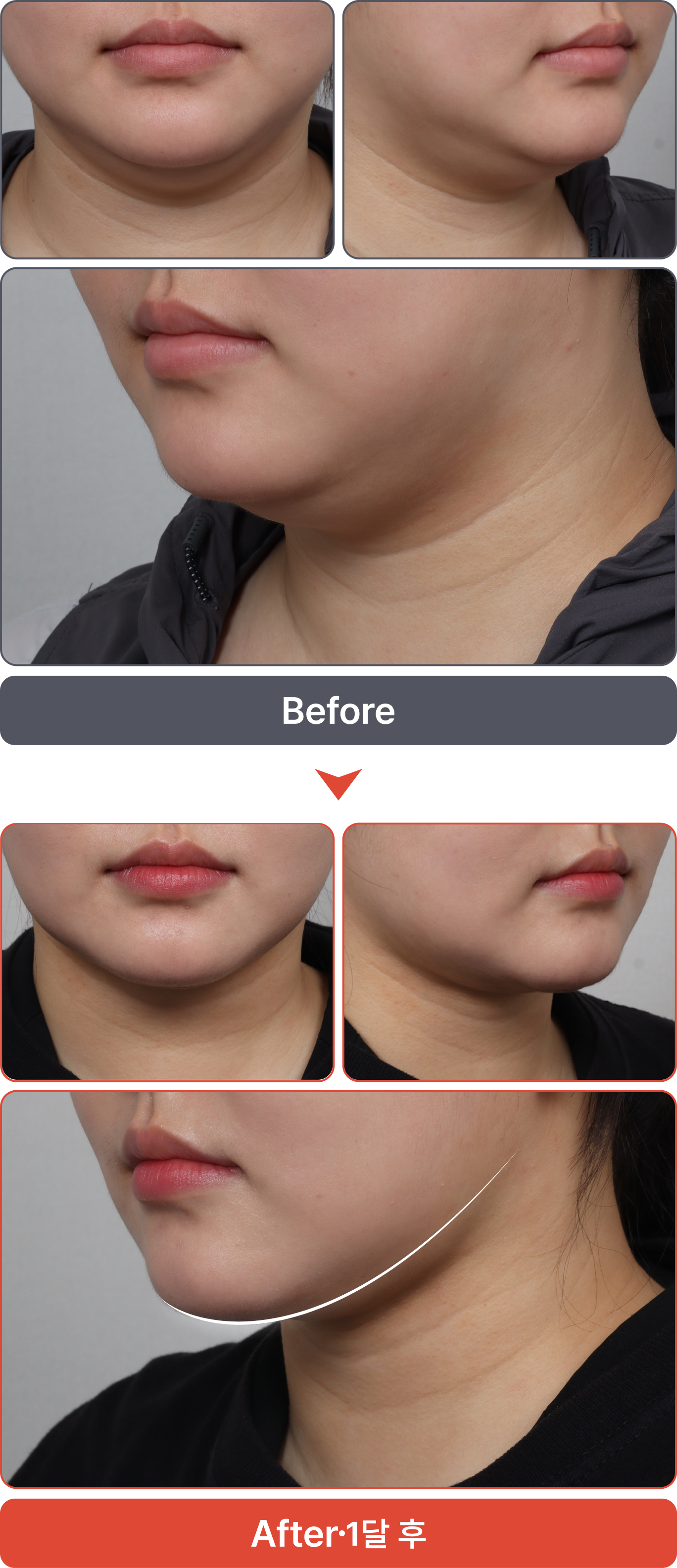 수술 전 이미지