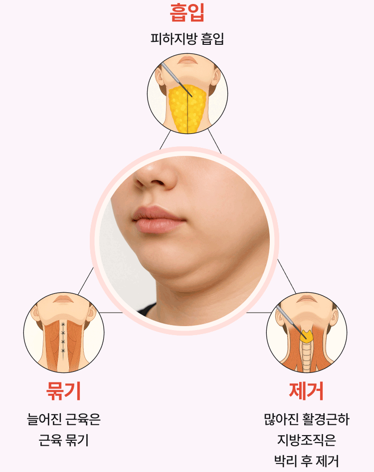 이중턱의 근본적 원인 해결 - 흡입, 묶기, 제거