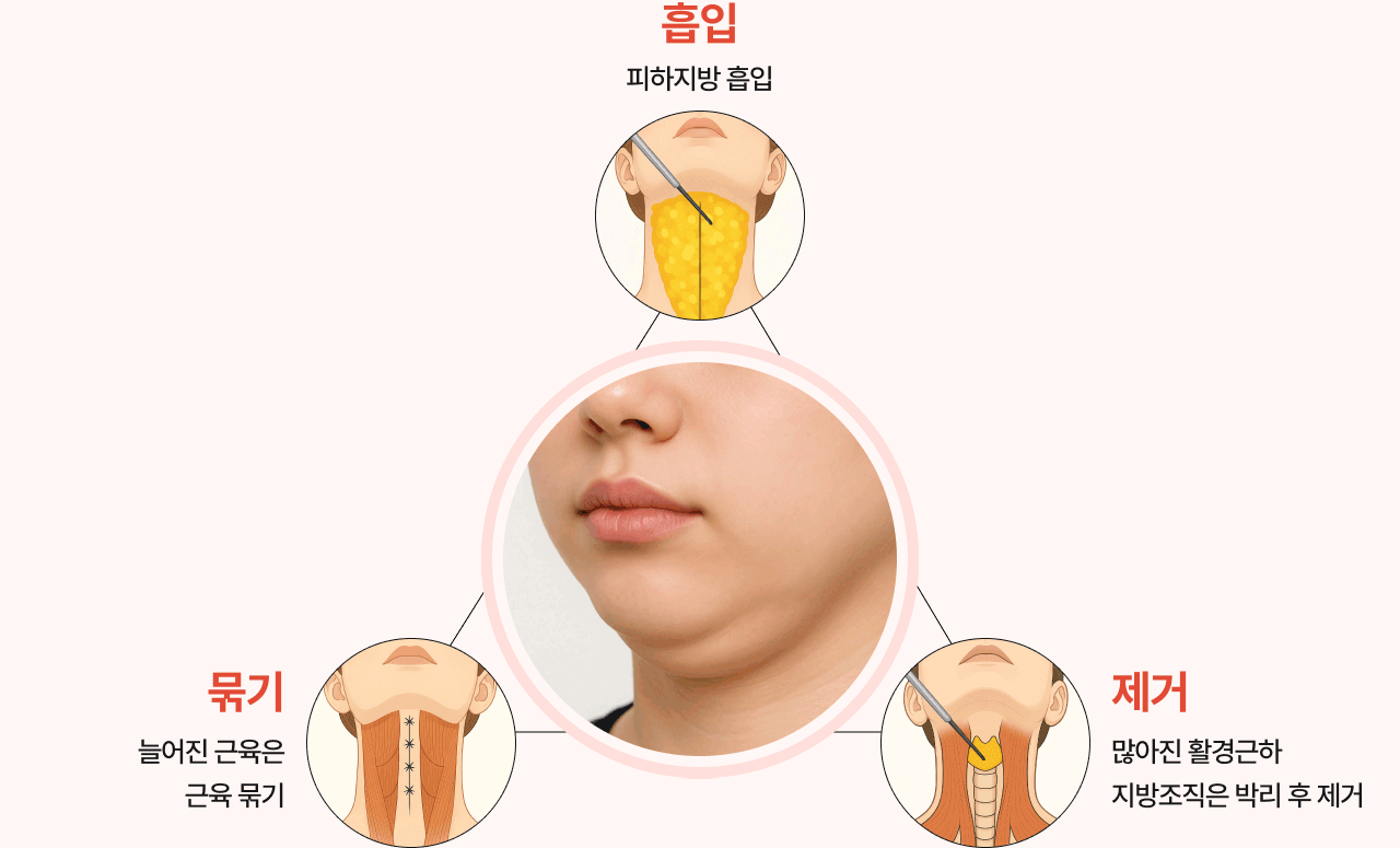 이중턱의 근본적 원인 해결 - 흡입, 묶기, 제거