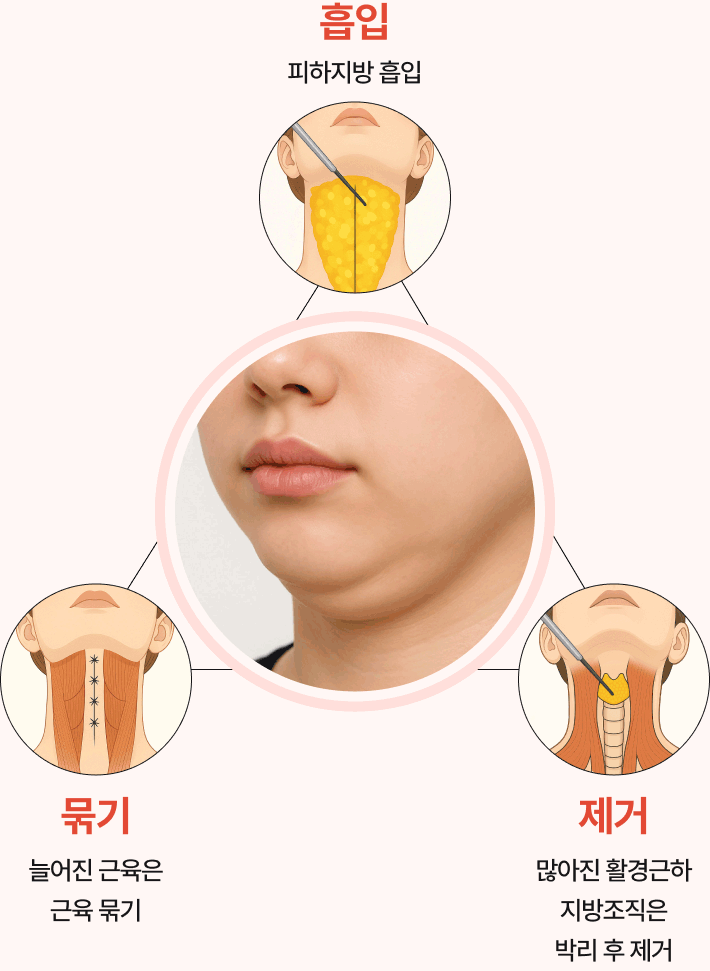 이중턱의 근본적 원인 해결 - 흡입, 묶기, 제거