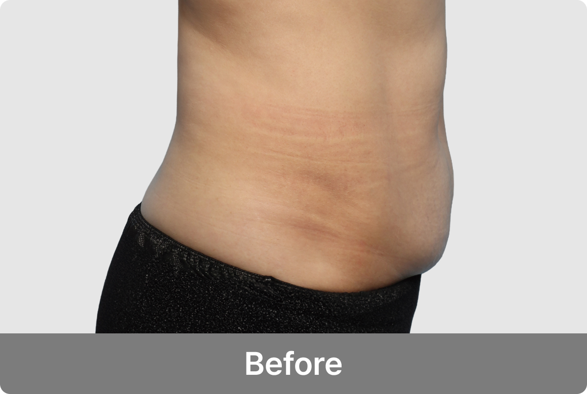 복부거상 수술 전 측면사진