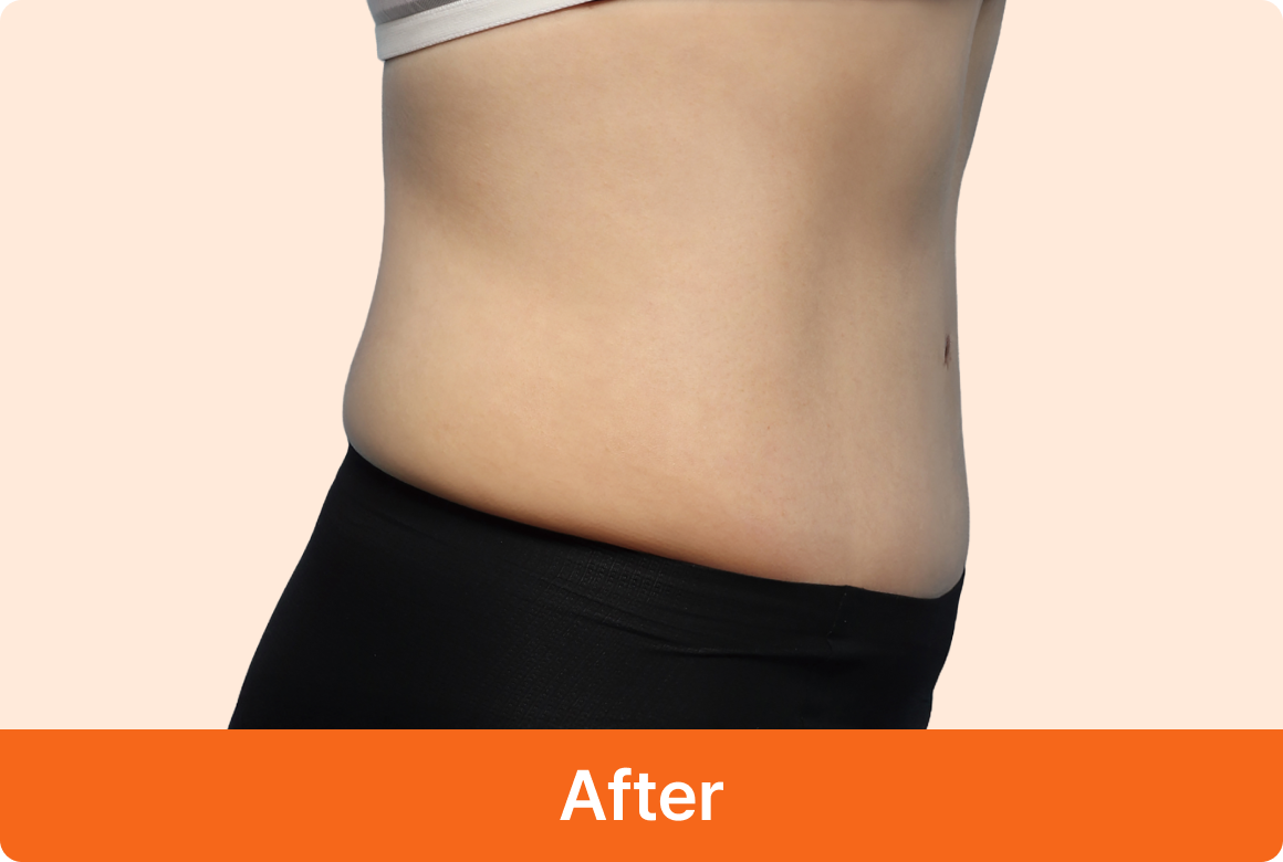 복부거상 수술 후 측면사진