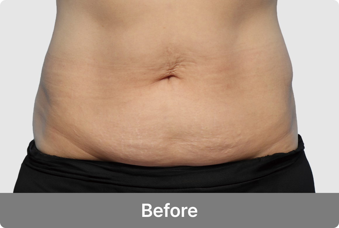 복부거상 수술 전 정면사진