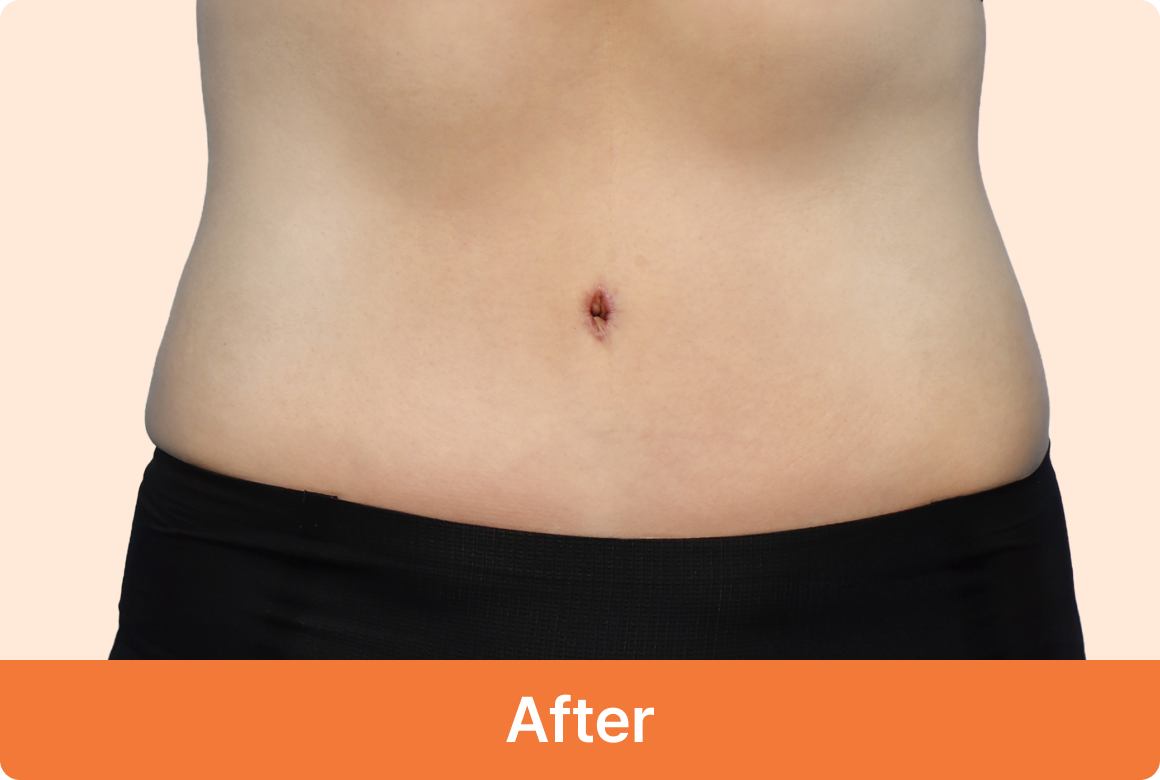 복부거상 수술 후 정면사진