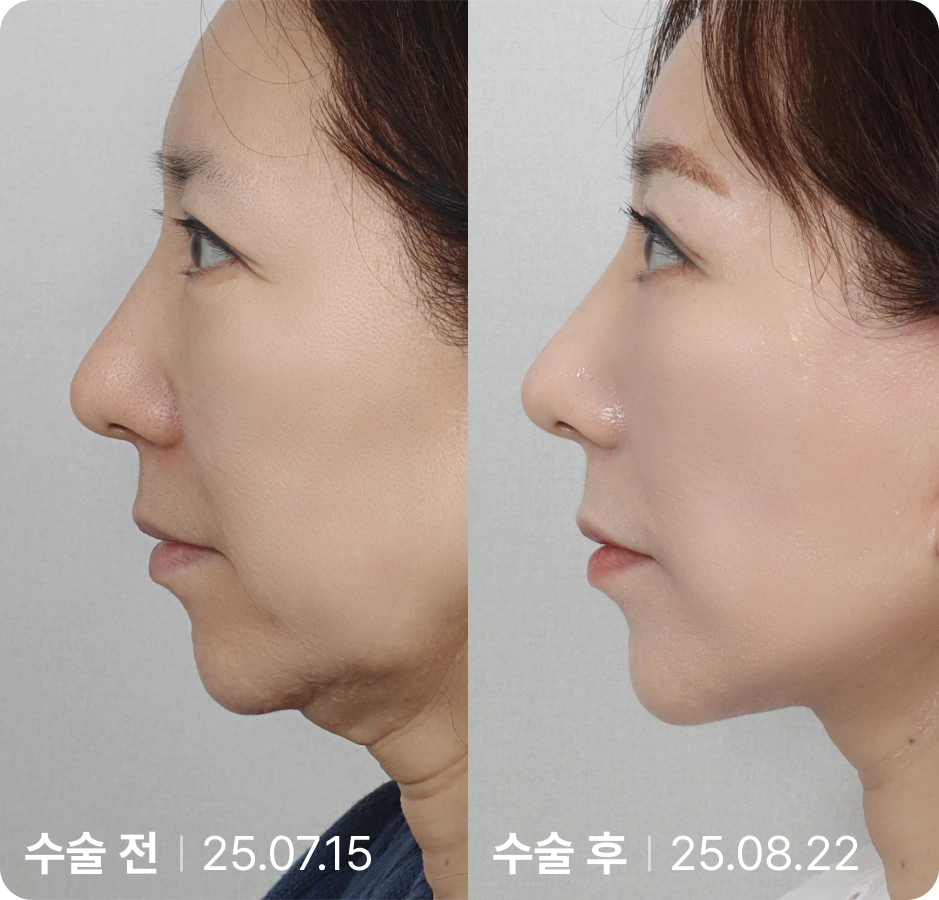 수술 전 | 수술 후