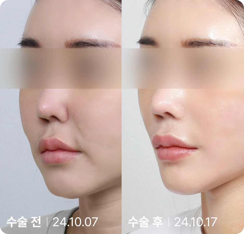 수술 전 | 수술 후